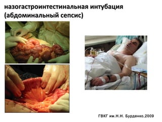 назогастроинтестинальная интубацияназогастроинтестинальная интубация
(абдоминальный сепсис)(абдоминальный сепсис)
ГВКГ им.Н.Н. Бурденко,2009
 