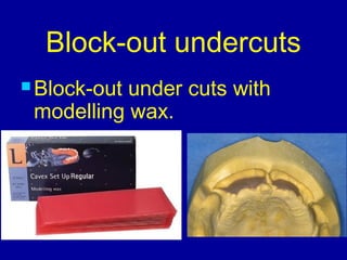 Block-out undercuts
 Block-out under cuts with
modelling wax.
 