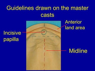 Anterior
land area
Midline
Incisive
papilla
Guidelines drawn on the master
casts
 