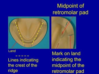 Lines indicating
the crest of the
ridge
Midpoint of
retromolar pad
Mark on land
indicating the
midpoint of the
retromolar ...