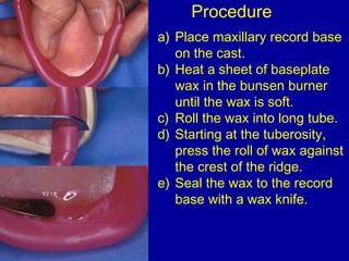 a) Place maxillary record base
on the cast.
b) Heat a sheet of baseplate
wax in the bunsen burner
until the wax is soft.
c...