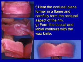 f) Heat the occlusal plane
former in a flame and
carefully form the occlusal
aspect of the rim.
g) Form the buccal and
lab...