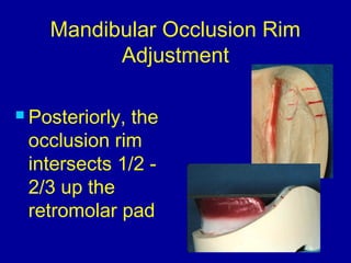 Mandibular Occlusion Rim
Adjustment
 Posteriorly, the
occlusion rim
intersects 1/2 -
2/3 up the
retromolar pad
 