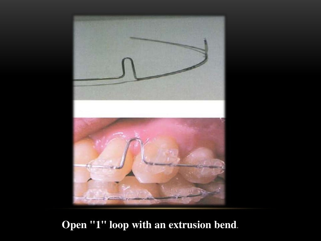 Space closure in orthodontics by elastics