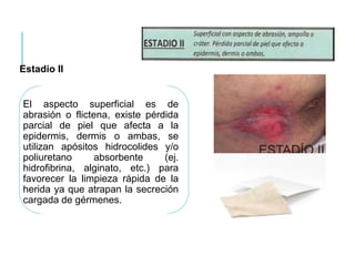 Estadio II
El aspecto superficial es de
abrasión o flictena, existe pérdida
parcial de piel que afecta a la
epidermis, dermis o ambas, se
utilizan apósitos hidrocolides y/o
poliuretano absorbente (ej.
hidrofibrina, alginato, etc.) para
favorecer la limpieza rápida de la
herida ya que atrapan la secreción
cargada de gérmenes.
 