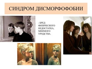 СИНДРОМ ДИСМОРФОФОБИИ
- БРЕД
ФИЗИЧЕСКОГО
НЕДОСТАТКА,
МНИМОГО
УРОДСТВА.
 