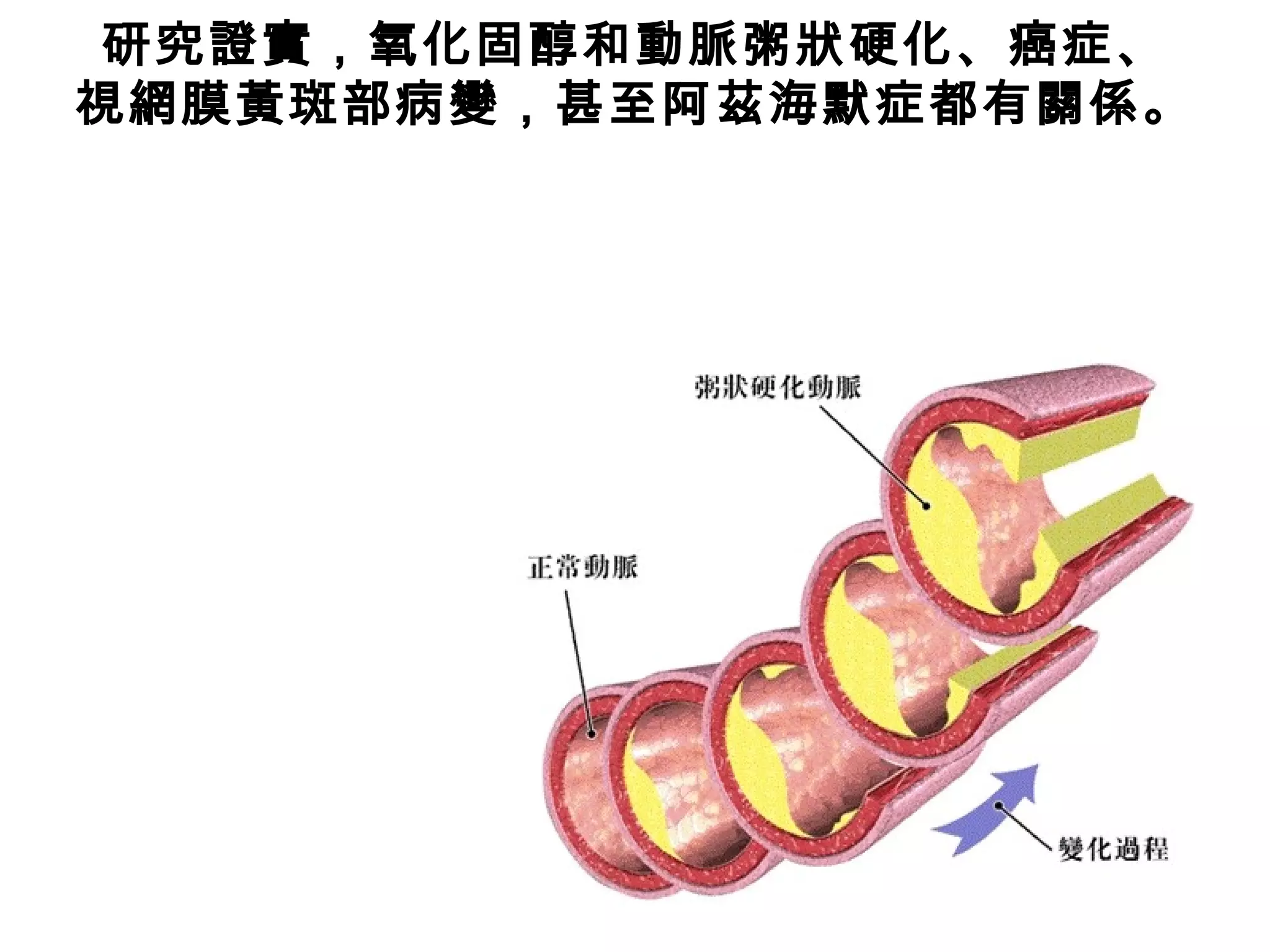 研究證實，氧化固醇和動脈粥狀硬化、癌症、
視網膜黃斑部病變，甚至阿茲海默症都有關係。
 
