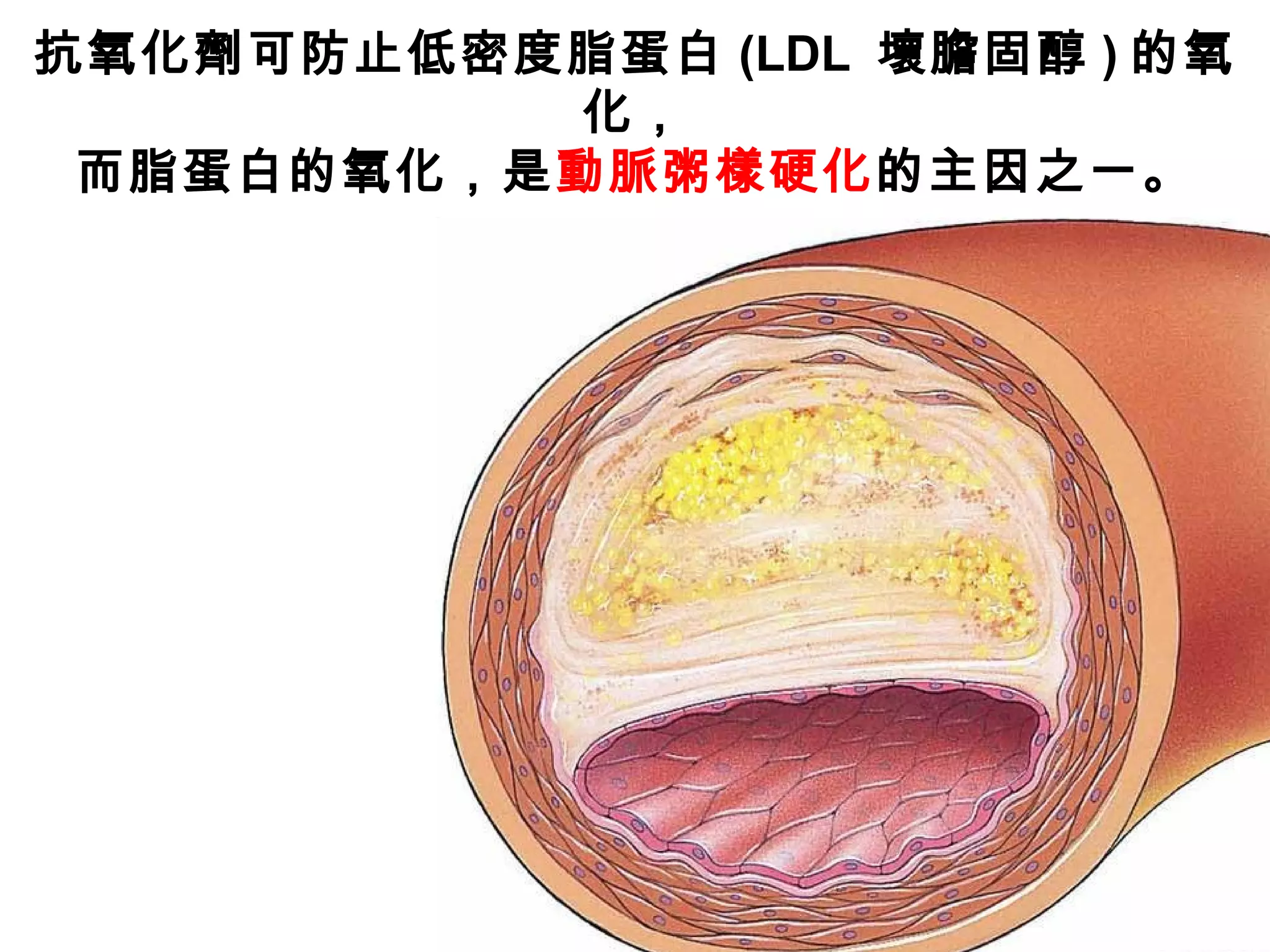 抗氧化劑可防止低密度脂蛋白 (LDL 壞膽固醇 ) 的氧
化，
而脂蛋白的氧化，是動脈粥樣硬化的主因之一。
 