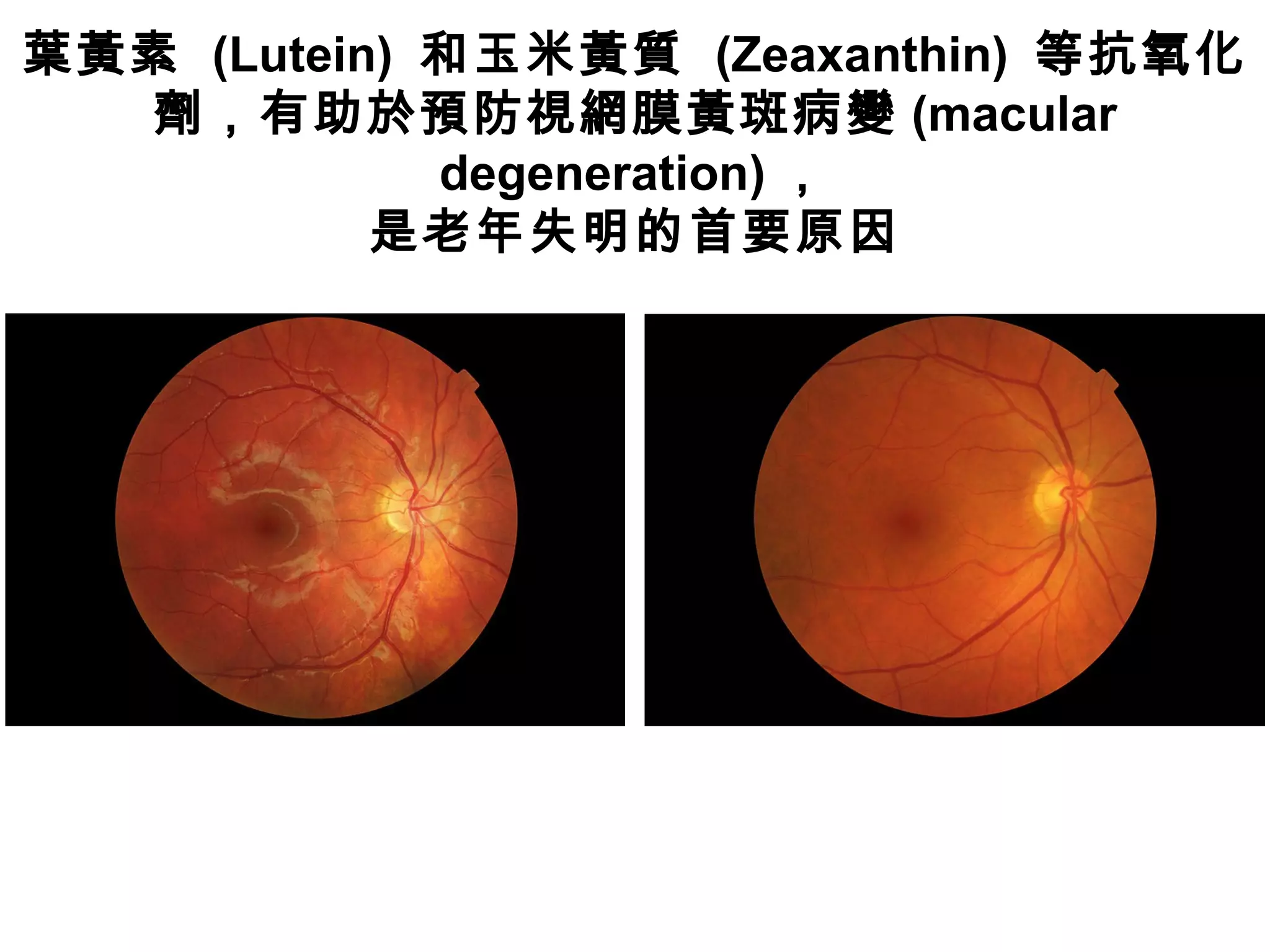 葉黃素 (Lutein) 和玉米黃質 (Zeaxanthin) 等抗氧化
劑，有助於預防視網膜黃斑病變 (macular
degeneration) ，
是老年失明的首要原因
 