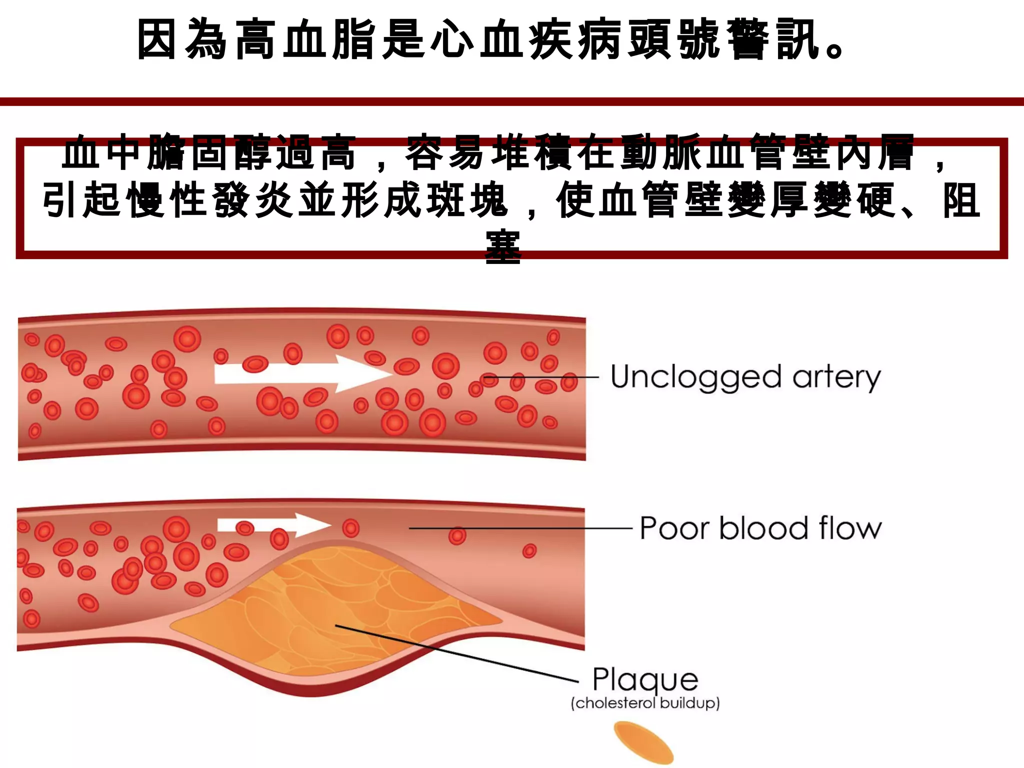 因為高血脂是心血疾病頭號警訊。
血中膽固醇過高，容易堆積在動脈血管壁內層，
引起慢性發炎並形成斑塊，使血管壁變厚變硬、阻
塞
 