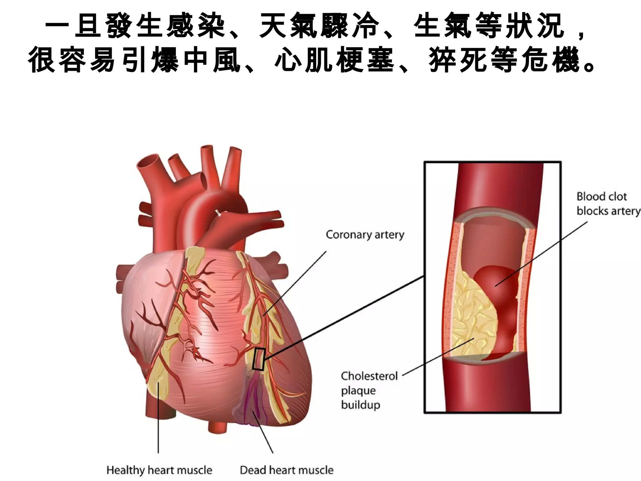 一旦發生感染、天氣驟冷、生氣等狀況，
很容易引爆中風、心肌梗塞、猝死等危機。
 