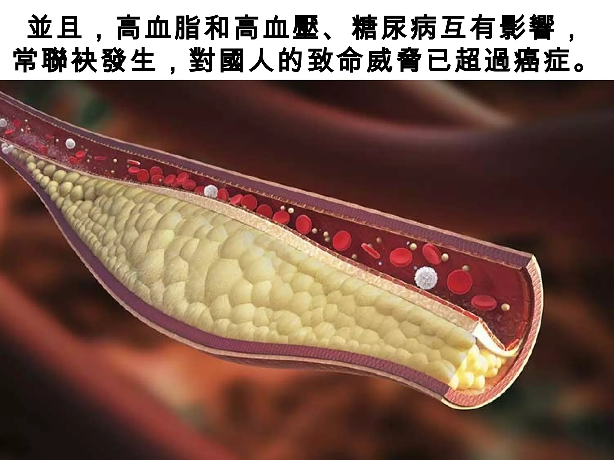 並且，高血脂和高血壓、糖尿病互有影響，
常聯袂發生，對國人的致命威脅已超過癌症。
 