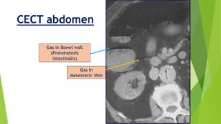Gas in
Mesenteric Vein
Gas in Bowel wall
(Pneumatosis
intestinalis)
CECT abdomen
 
