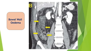 Bowel Wall
Oedema
 