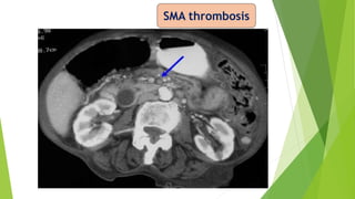 SMA thrombosis
 