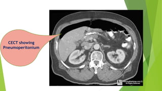 CECT showing
Pneumoperitonium
 