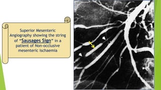 Superior Mesenteric
Angiography showing the string
of “Sausages Sign” in a
patient of Non-occlusive
mesenteric ischaemia
 