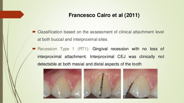 5 gingival recession seminar gingival recession