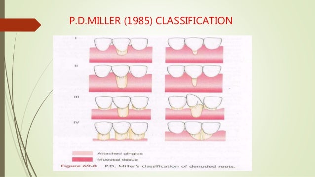 5 gingival recession seminar miller classification