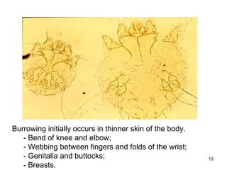 13
small male large female
Burrowing initially occurs in thinner skin of the body.
- Bend of knee and elbow;
- Webbing between fingers and folds of the wrist;
- Genitalia and buttocks;
- Breasts.
 