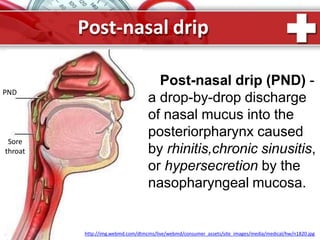 Post-nasal drip
Post-nasal drip (PND) -
a drop-by-drop discharge
of nasal mucus into the
posteriorpharynx caused
by rhinitis,chronic sinusitis,
or hypersecretion by the
nasopharyngeal mucosa.
http://img.webmd.com/dtmcms/live/webmd/consumer_assets/site_images/media/medical/hw/n1820.jpgP
PND
Sore
throat
 