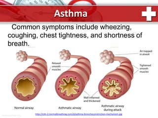 Asthma
Common symptoms include wheezing,
coughing, chest tightness, and shortness of
breath.
http://cdn-2.normalbreathing.com/d/asthma-bronchoconstriction-mechanism.jpg
ProPowerPoint.Ru
 