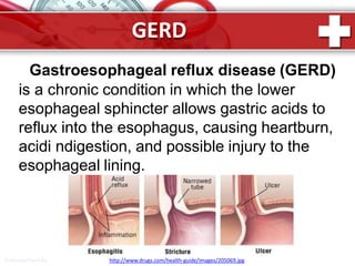 GERD
Gastroesophageal reflux disease (GERD)
is a chronic condition in which the lower
esophageal sphincter allows gastric acids to
reflux into the esophagus, causing heartburn,
acidi ndigestion, and possible injury to the
esophageal lining.
ProPowerPoint.Ru http://www.drugs.com/health-guide/images/205069.jpg
 