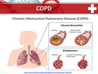 COPD
ProPowerPoint.Ru http://www.earthtimes.org/newsimage/tai-chi-therapy-copd_29812.jpg
 