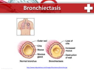 Bronchiectasis
http://www.mdguidelines.com/images/Illustrations/bronchie.jpg
ProPowerPoint.Ru
 