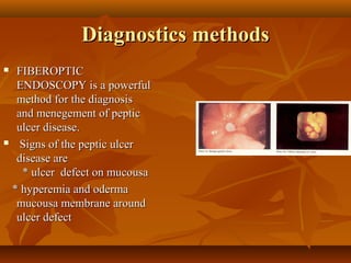 Diagnostics methodsDiagnostics methods
 FIBEROPTICFIBEROPTIC
ENDOSCOPY is a powerfulENDOSCOPY is a powerful
method for the diagnosismethod for the diagnosis
and menegement of pepticand menegement of peptic
ulcer disease.ulcer disease.
 Signs of the peptic ulcerSigns of the peptic ulcer
disease aredisease are
* ulcer defect on mucousa* ulcer defect on mucousa
* hyperemia and oderma* hyperemia and oderma
mucousa membrane aroundmucousa membrane around
ulcer defectulcer defect
 