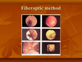 Fiberoptic methodFiberoptic method
 