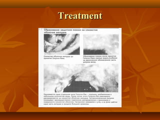 TreatmentTreatment
 