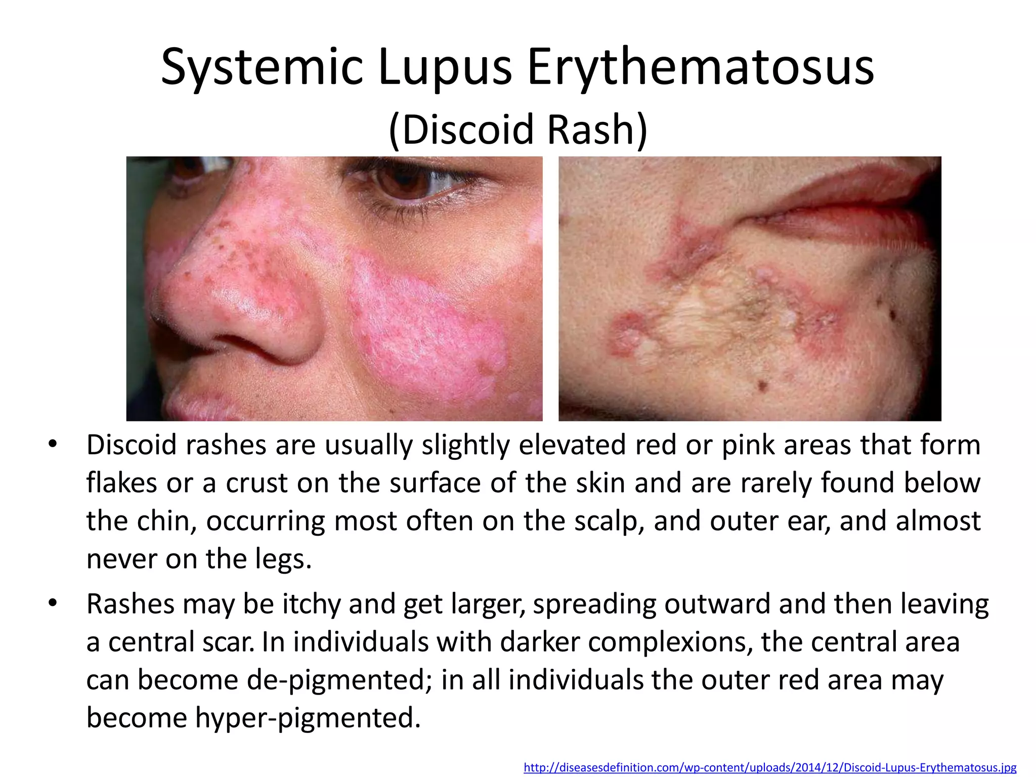 Systemic Connective Tissue Diseases | PPTX