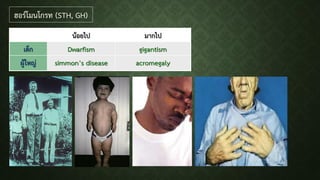 น้อยไป มากไป
เด็ก Dwarfism gigantism
ผู้ใหญ่ simmon’s disease acromegaly
ฮอร์โมนโกรท (STH, GH)
 