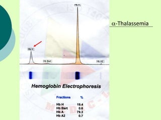 -Thalassemia
 