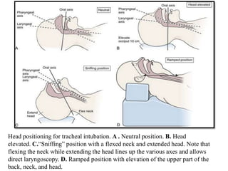 Intubation Ramping Endotracheal intubation in oral & maxillofacial surgery | PPTX