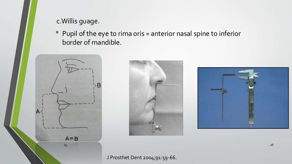 Vertical jaw relation in Complete Dentures Kelly