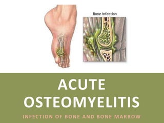ACUTE
OSTEOMYELITIS
INFECTION OF BONE AND BONE MARROW
 