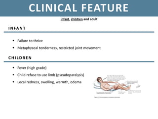 CLINICAL FEATURE
infant, children and adult
I NFANT
 Failure to thrive
 Metaphyseal tenderness, restricted joint movement
CHI L DREN
 Fever (high grade)
 Child refuse to use limb (pseudoparalysis)
 Local redness, swelling, warmth, odema
 