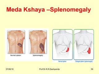 Meda Kshaya –Splenomegaly
07/06/18 Prof.Dr.R.R.Deshpande 59
 