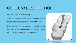 OCCLUSAL REDUCTION
•Improve access and the visibility
•When the cusps are reduced, it is easier to assess the
height of the remaining clinical crown of the tooth
•Using the No. 271 carbide bur held parallel to the
long axis of the tooth crown, a 2-mm deep pulpal
floor is prepared along the central groove
 