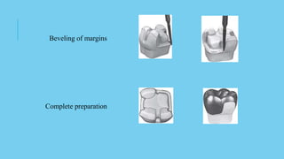 Beveling of margins
Complete preparation
 