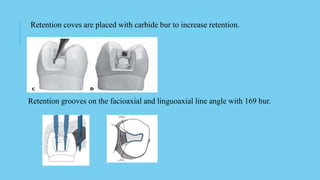 Retention coves are placed with carbide bur to increase retention.
Retention grooves on the facioaxial and linguoaxial line angle with 169 bur.
 