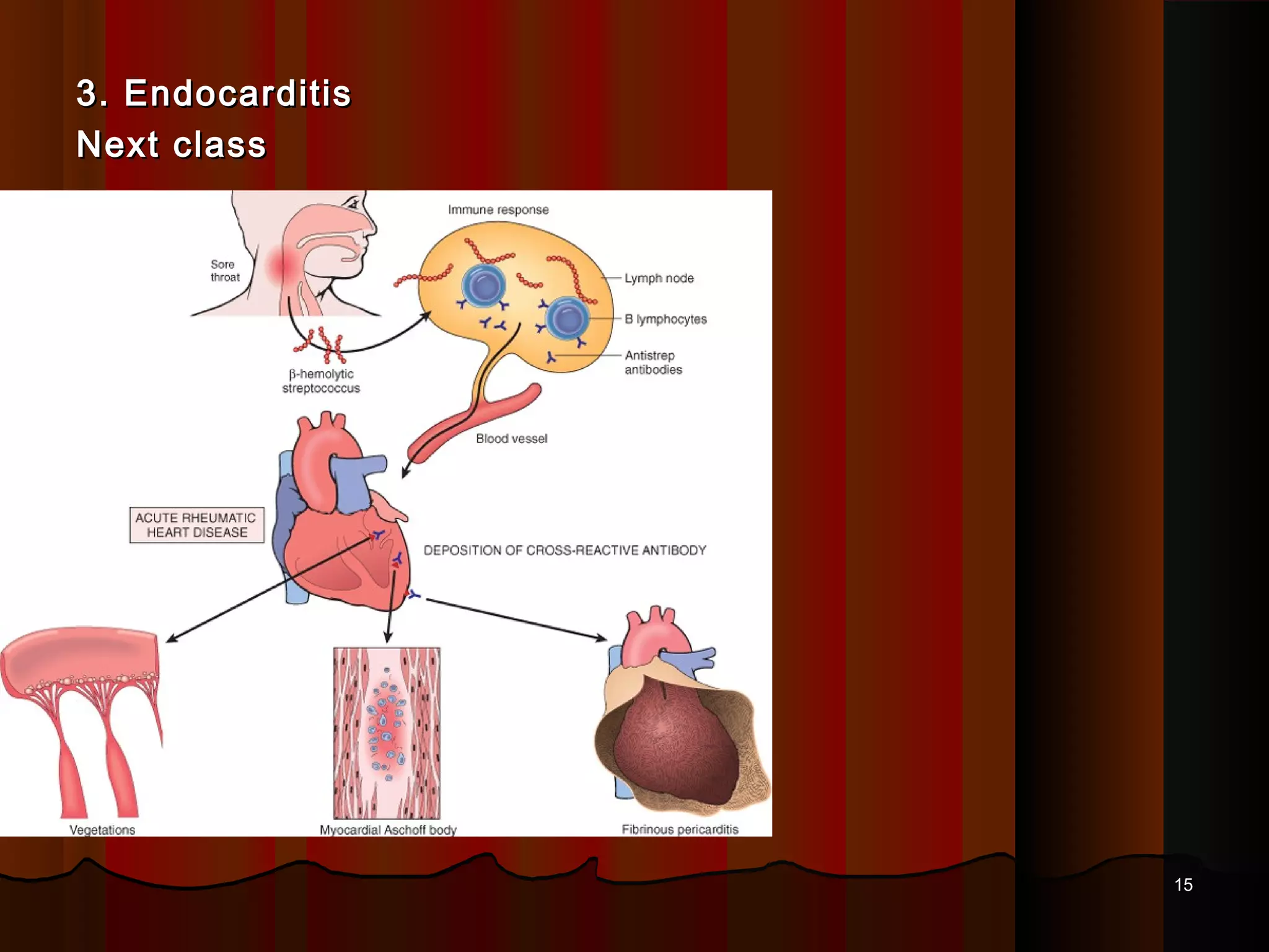 Patofisiologi Rhd 5.Rheumatic heart disease pathology | PPT