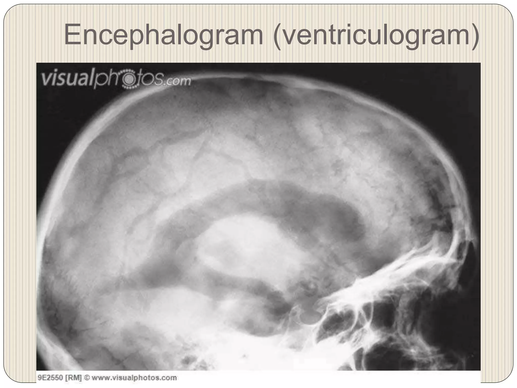 Encephalogram (ventriculogram)
 