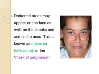  Darkened areas may
appear on the face as
well, on the cheeks and
across the nose. This is
known as melasma
(chloasma), or the
“mask of pregnancy.”
 