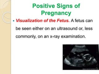 Positive Signs of
Pregnancy
 Visualization of the Fetus. A fetus can
be seen either on an ultrasound or, less
commonly, on an x-ray examination.
 