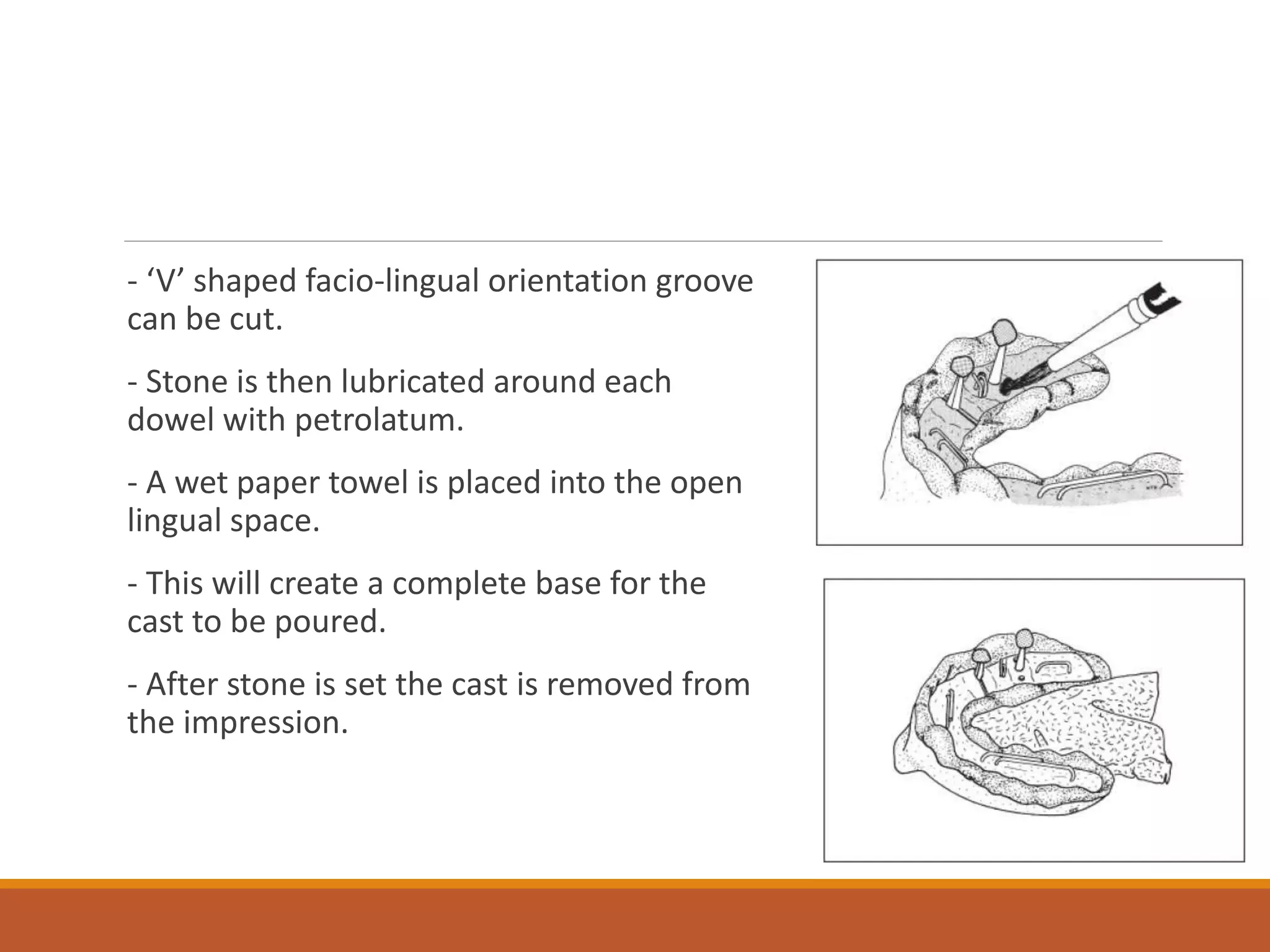 - ‘V’ shaped facio-lingual orientation groove
can be cut.
- Stone is then lubricated around each
dowel with petrolatum.
- A wet paper towel is placed into the open
lingual space.
- This will create a complete base for the
cast to be poured.
- After stone is set the cast is removed from
the impression.
 