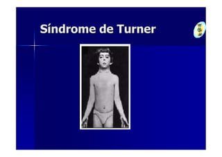 Síndrome de Turner
 