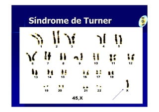 Síndrome de Turner
 